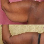Arm Lift (Brachioplasty) Before & After Patient #14773