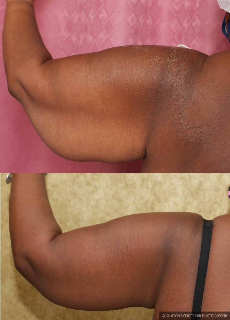 Arm Lift (Brachioplasty) Before & After Patient #14773