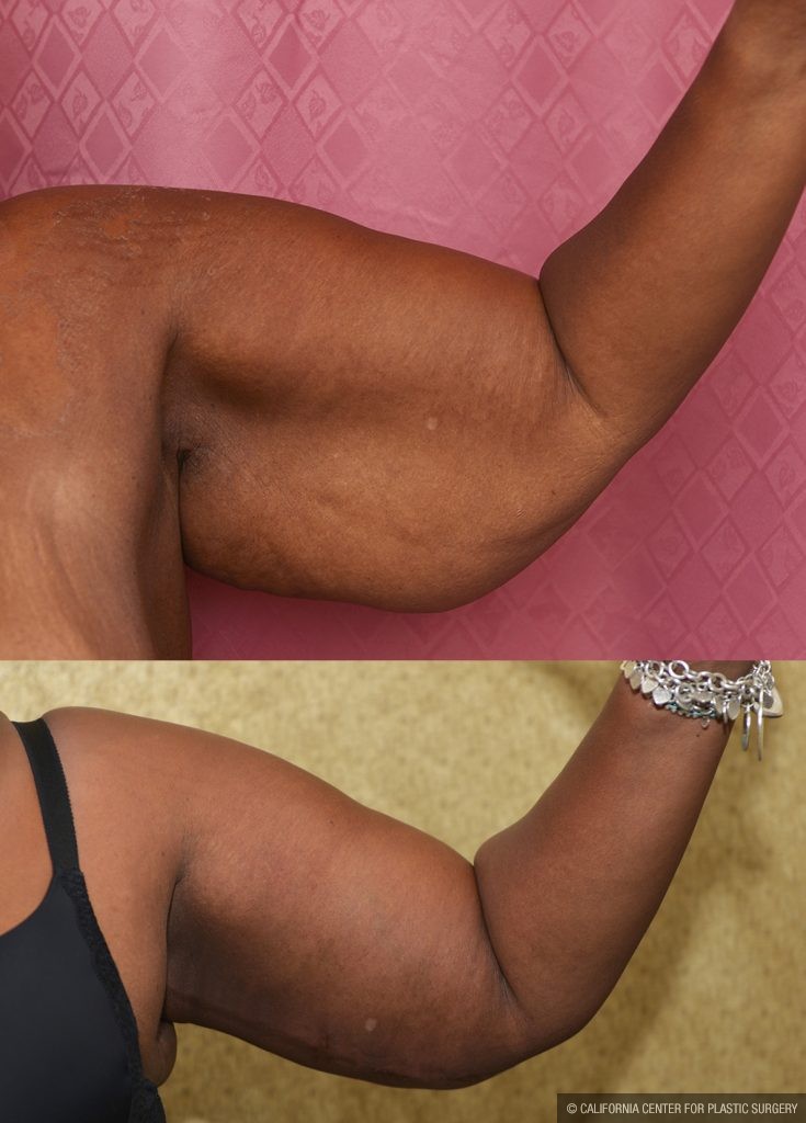 Arm Lift (Brachioplasty) Before & After Patient #14773