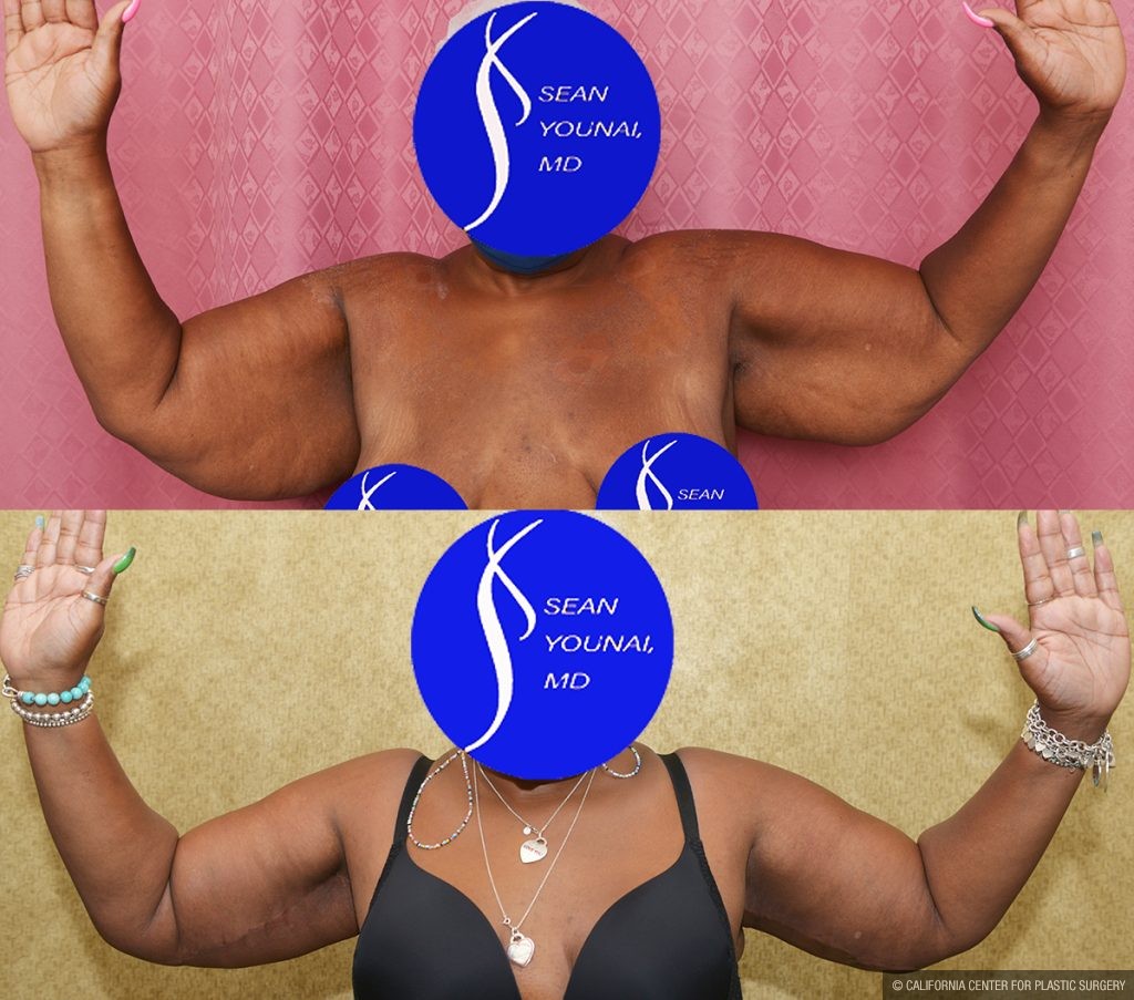 Arm Lift (Brachioplasty) Before & After Patient #14773