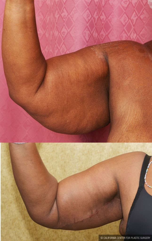 Arm Lift (Brachioplasty) Before & After Patient #14773