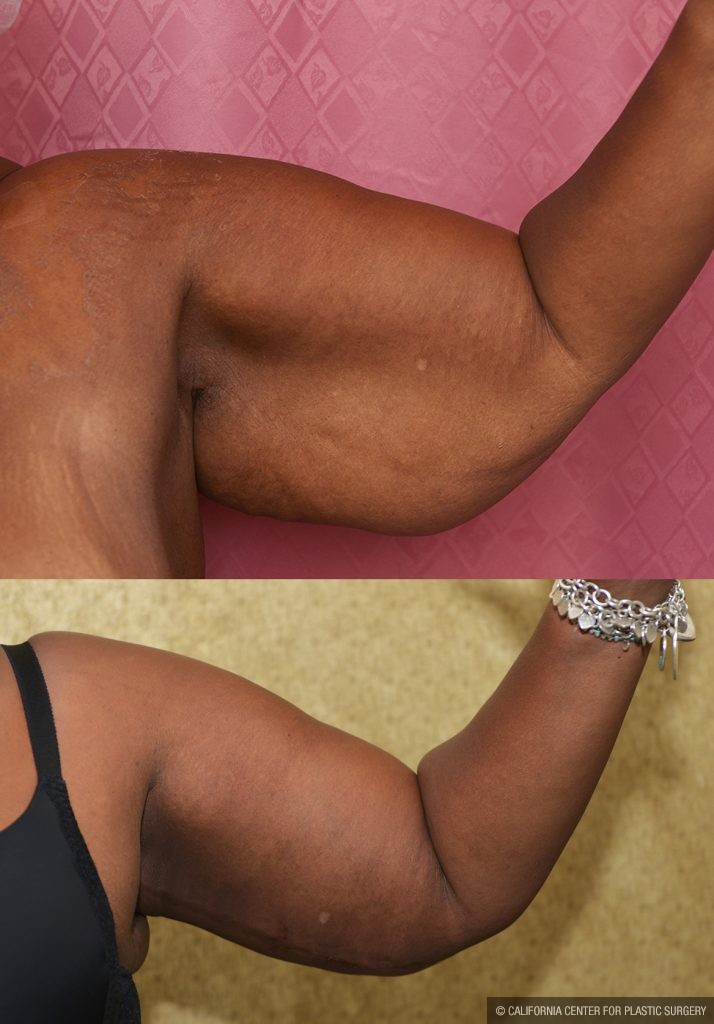 Arm Lift (Brachioplasty) Before & After Patient #14773