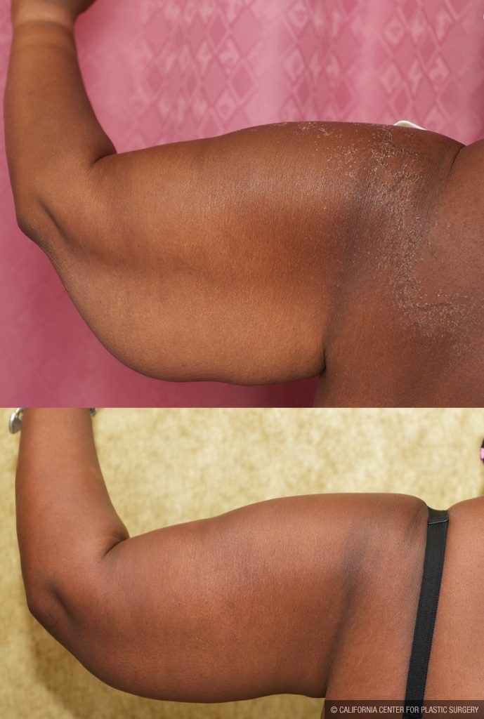 Arm Lift (Brachioplasty) Before & After Patient #14773