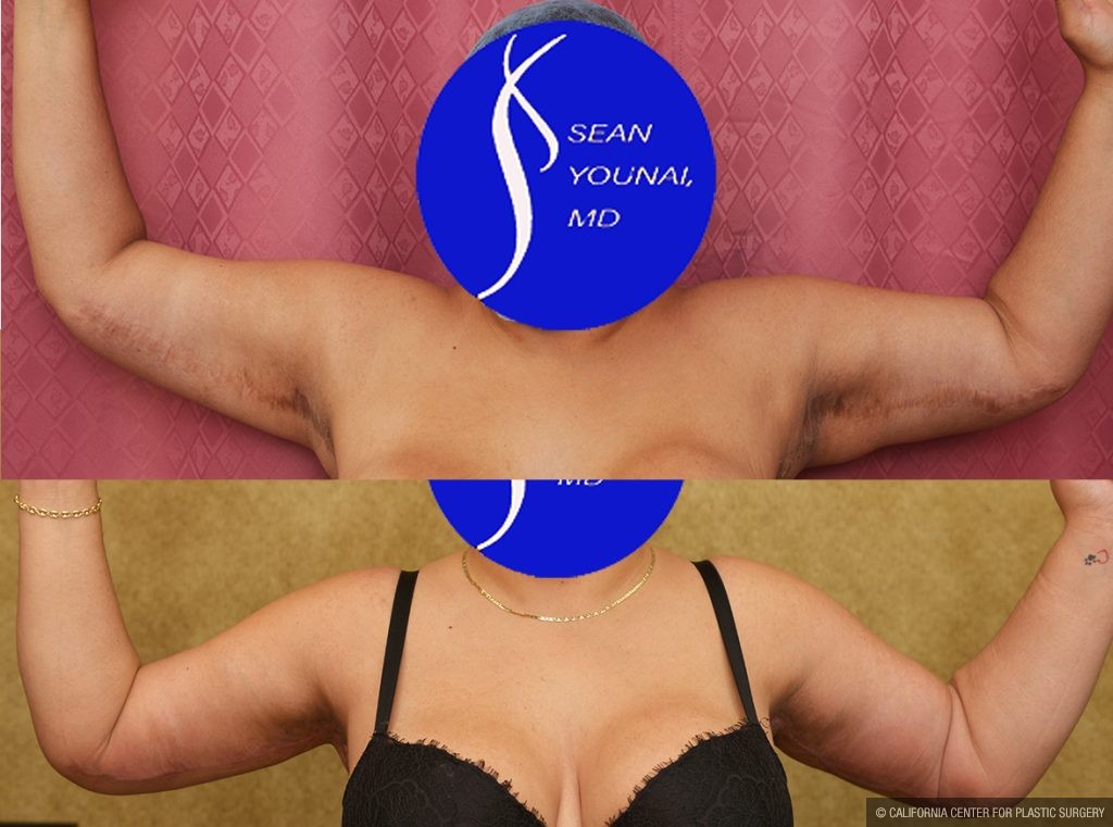 Arm Lift (Brachioplasty) Before & After Patient #14774