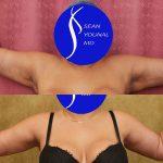 Arm Lift (Brachioplasty) Before & After Patient #14774