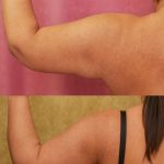 Arm Lift (Brachioplasty) Before & After Patient #14774