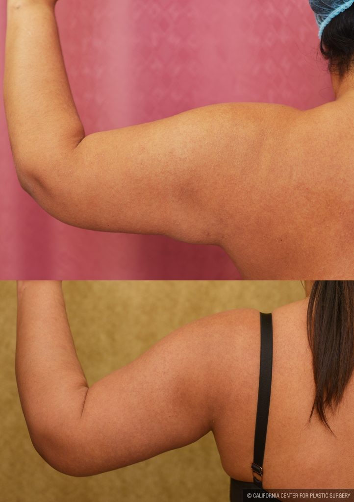 Arm Lift (Brachioplasty) Before & After Patient #14774