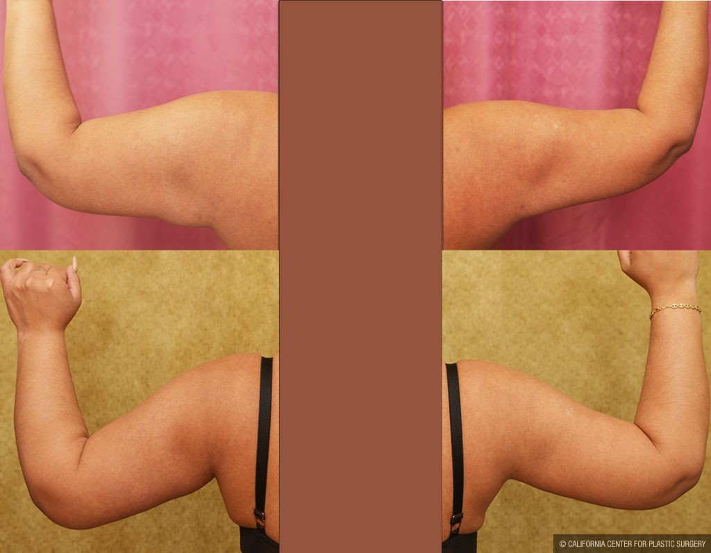 Arm Lift (Brachioplasty) Before & After Patient #14774