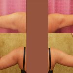 Arm Lift (Brachioplasty) Before & After Patient #14774