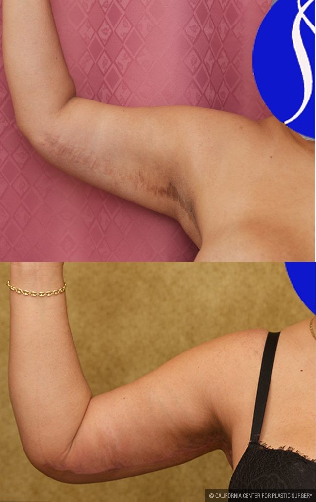 Arm Lift (Brachioplasty) Before & After Patient #14774