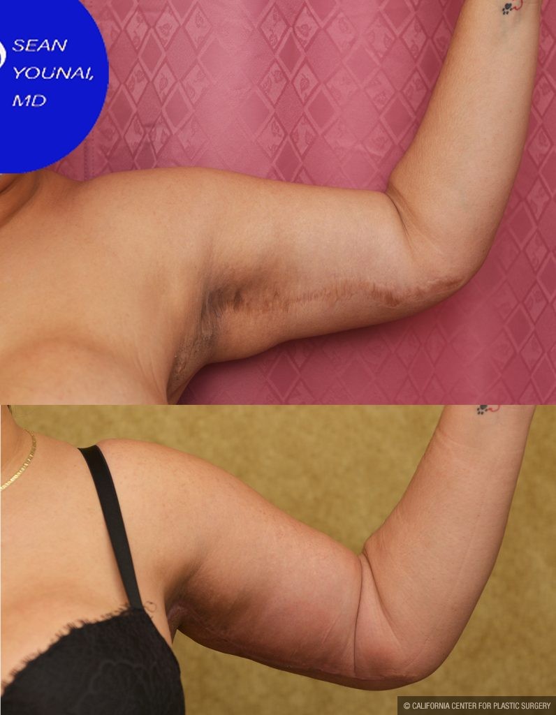 Arm Lift (Brachioplasty) Before & After Patient #14774