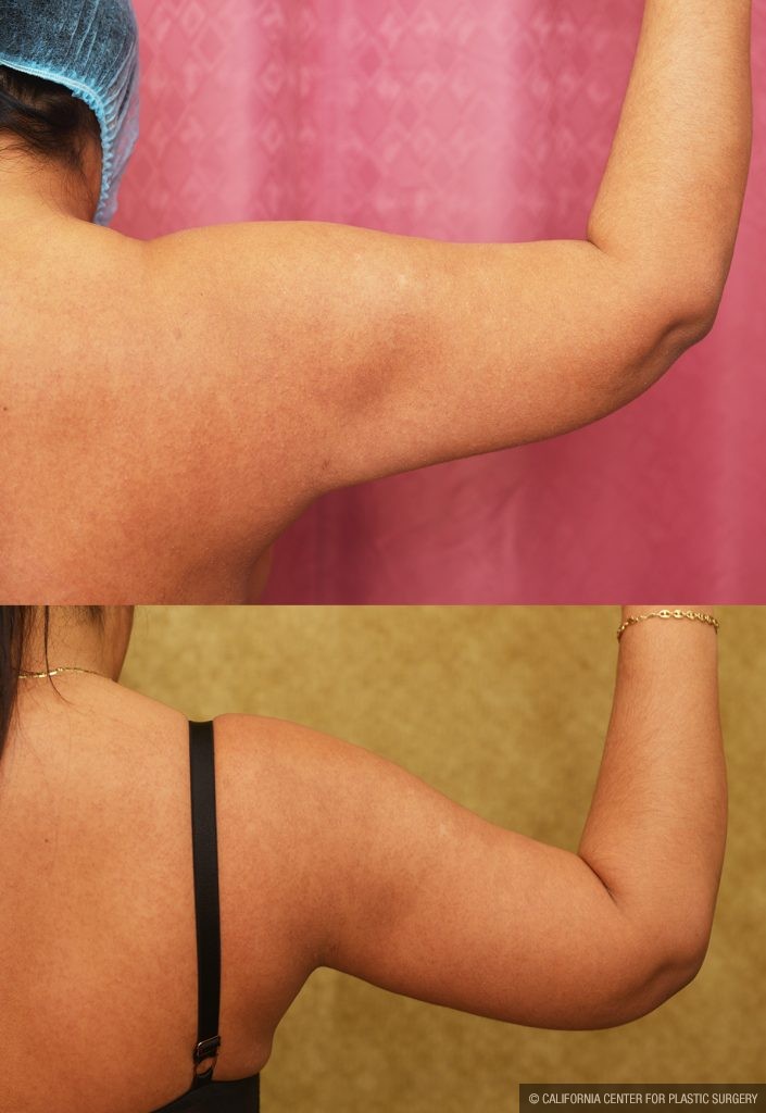 Arm Lift (Brachioplasty) Before & After Patient #14774