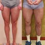 Calf Augmentation Before & After Patient #14777