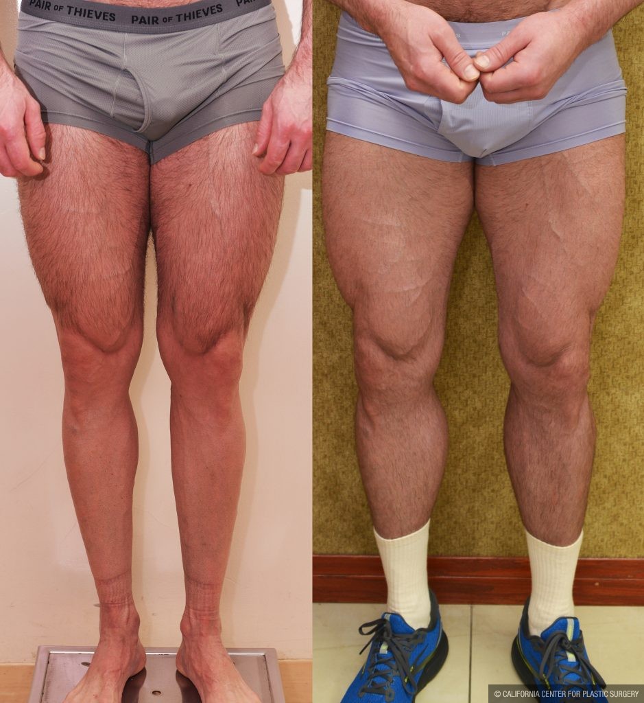 Calf Augmentation Before & After Patient #14777
