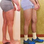 Calf Augmentation Before & After Patient #14777