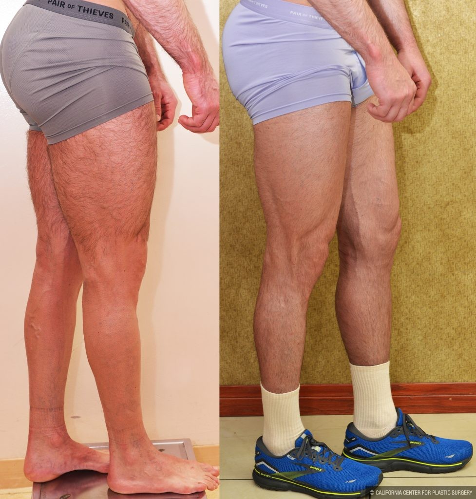 Calf Augmentation Before & After Patient #14777