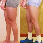 Calf Augmentation Before & After Patient #14777
