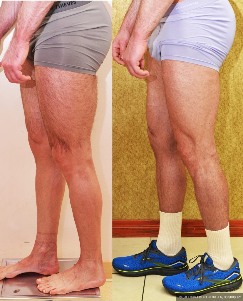 Calf Augmentation Before & After Patient #14777