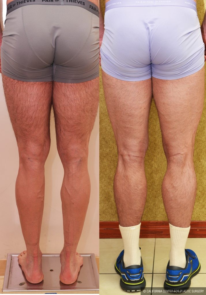 Calf Augmentation Before & After Patient #14777