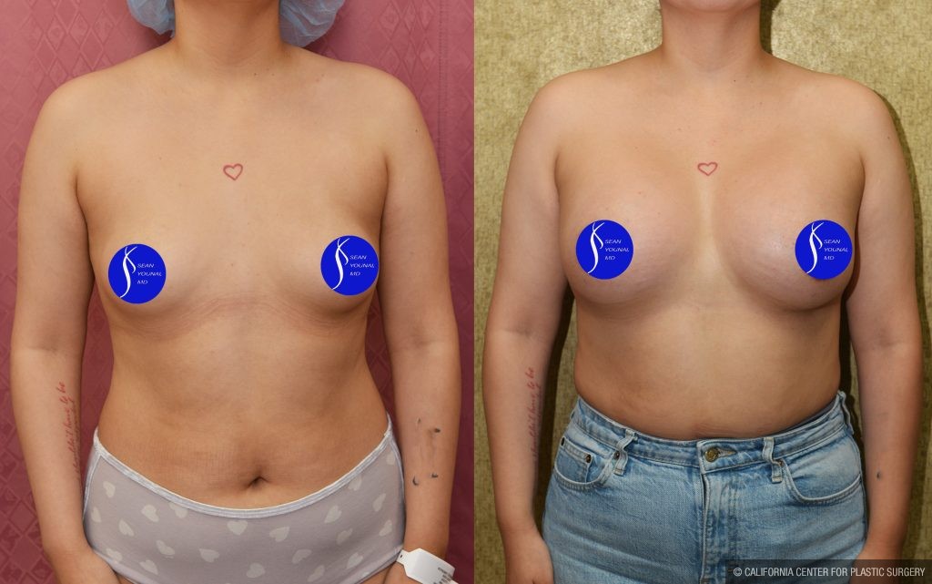 Breast Augmentation Before & After Patient #14906