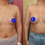 Breast Augmentation Before & After Patient #14906