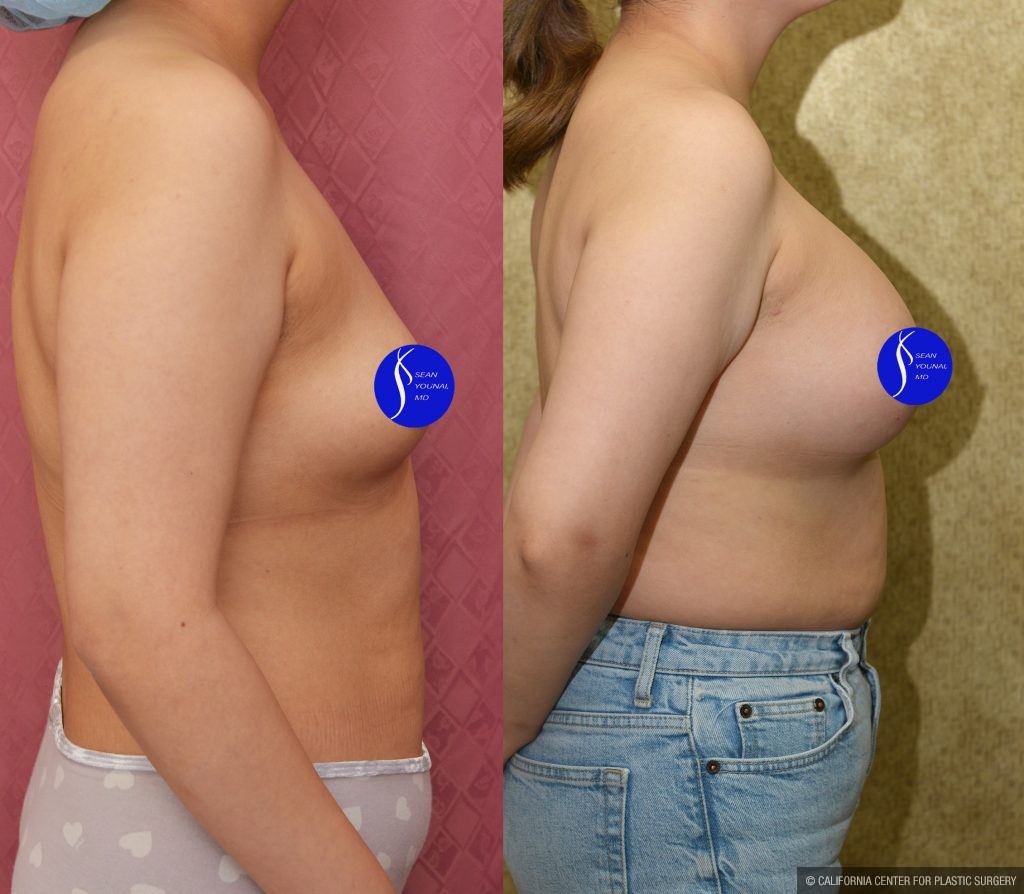 Breast Augmentation Before & After Patient #14906