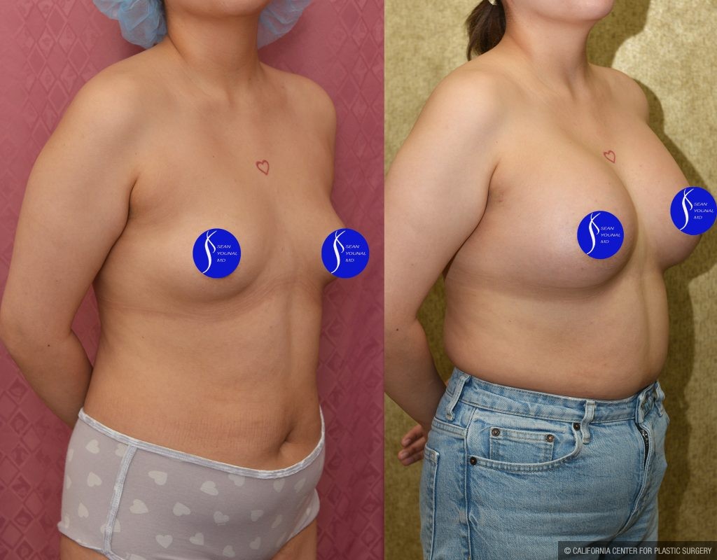 Breast Augmentation Before & After Patient #14906