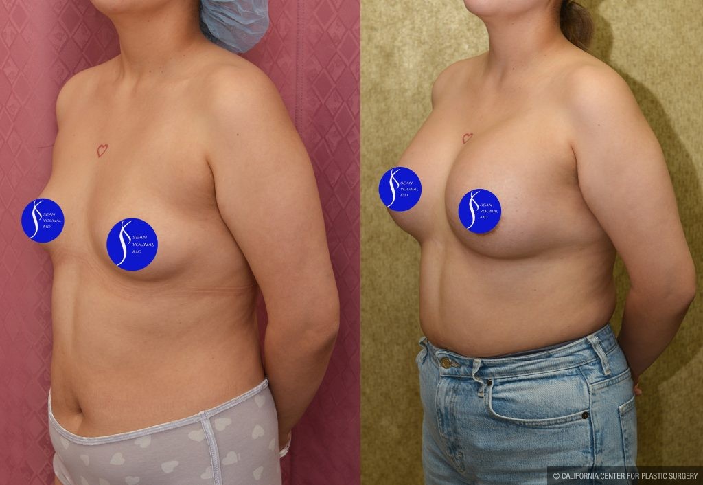 Breast Augmentation Before & After Patient #14906