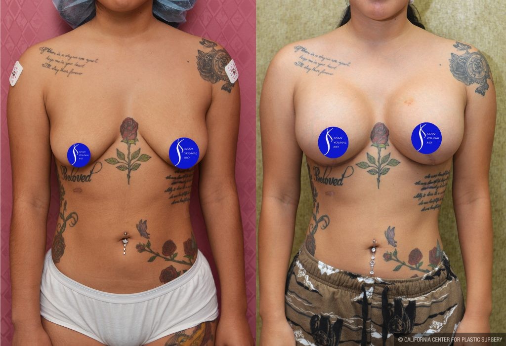 Breast Lift - Moderate Before & After Patient #14907
