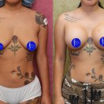 Breast Lift - Moderate Before & After Patient #14907