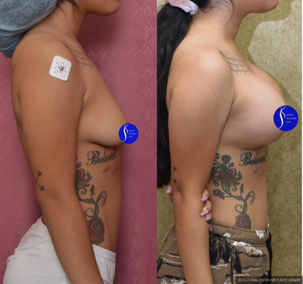 Breast Lift - Moderate Before & After Patient #14907