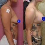 Breast Lift - Moderate Before & After Patient #14907
