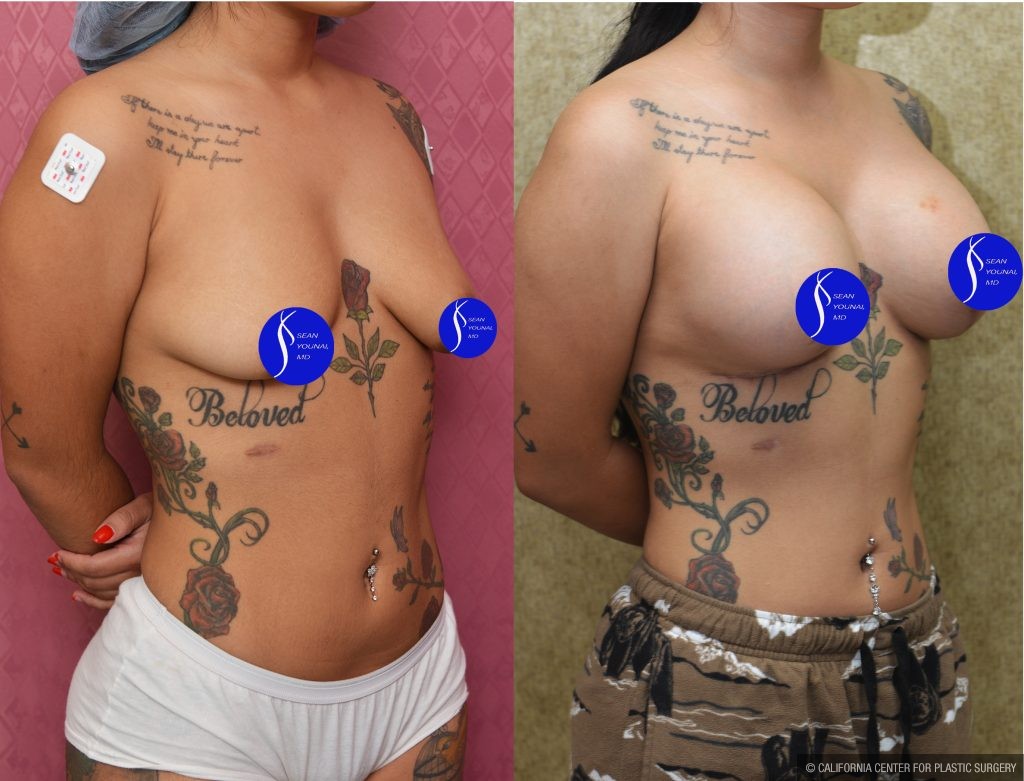 Breast Lift - Moderate Before & After Patient #14907