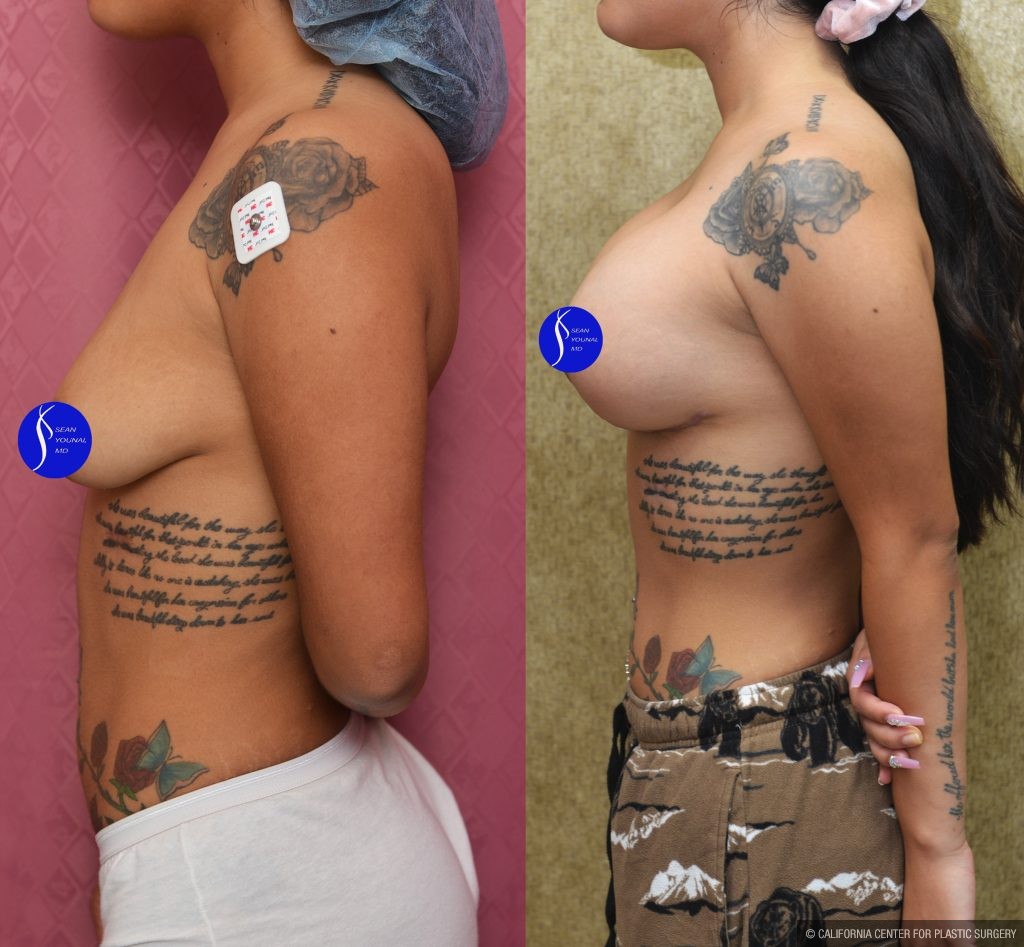 Breast Lift - Moderate Before & After Patient #14907