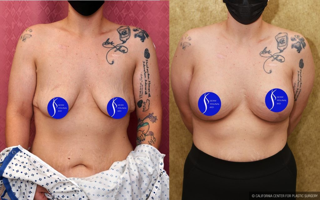 Breast Lift - Limited Before & After Patient #14908