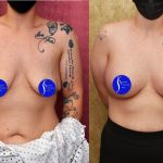 Breast Lift - Limited Before & After Patient #14908