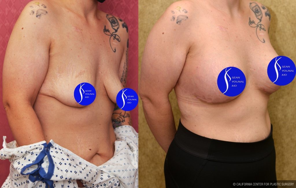 Breast Lift - Limited Before & After Patient #14908