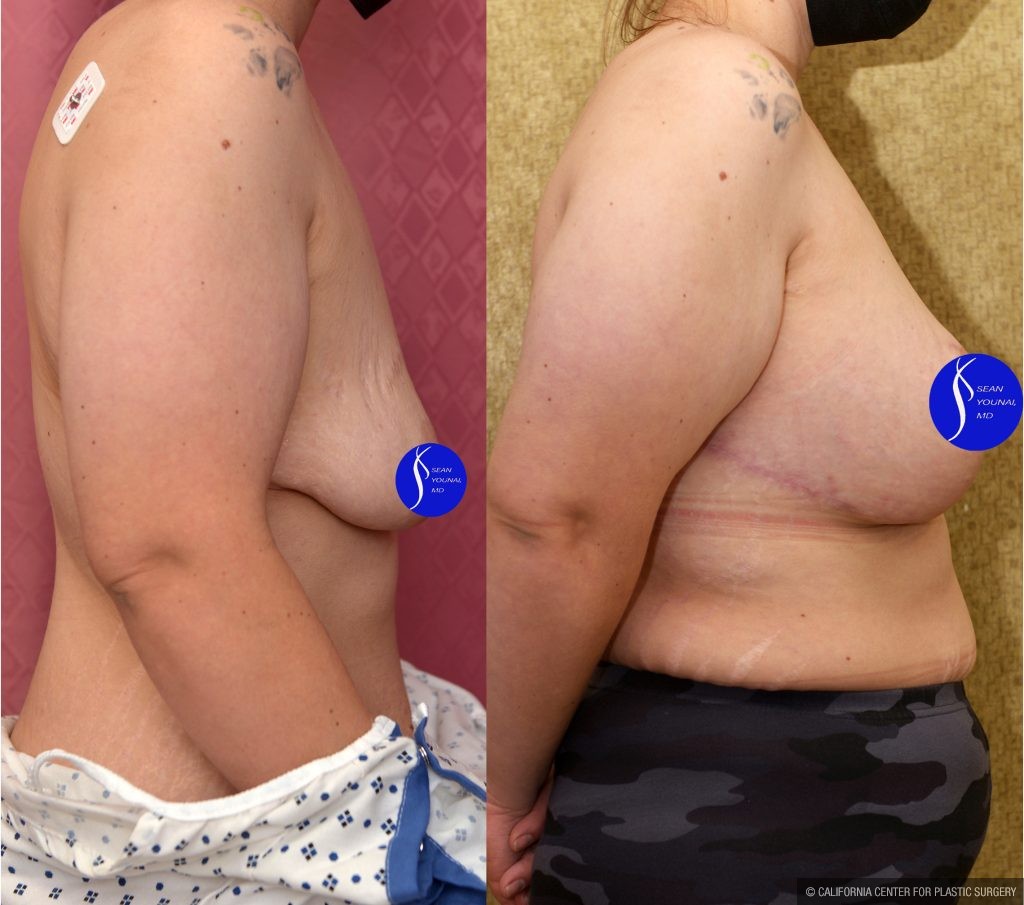 Breast Lift - Limited Before & After Patient #14908