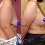 Breast Lift - Limited Before & After Patient #14908