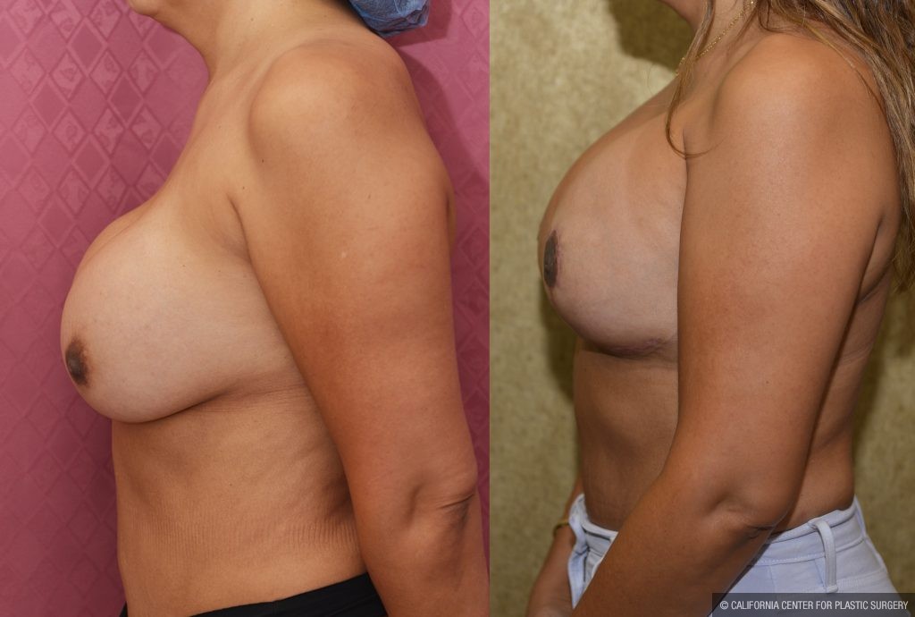 Breast Augmentation (Revision) Before & After Patient #14909