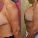 Breast Augmentation (Revision) Before & After Patient #14909