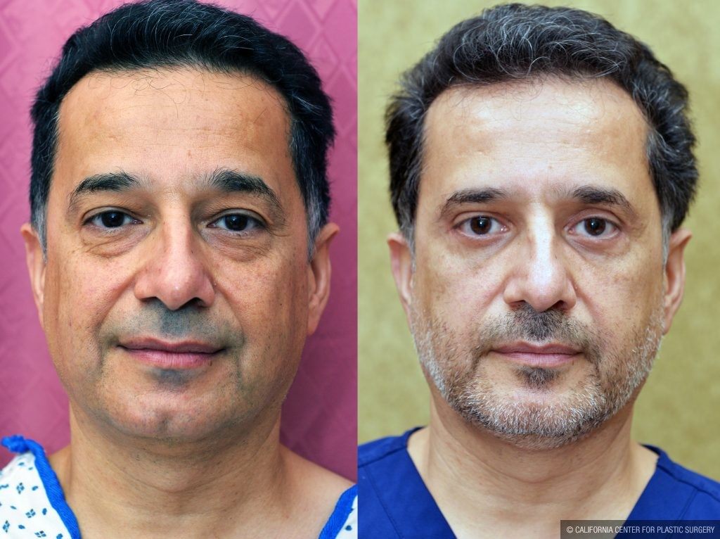 Eyelid (Blepharoplasty) Before & After Patient #14911