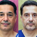 Eyelid (Blepharoplasty) Before & After Patient #14911