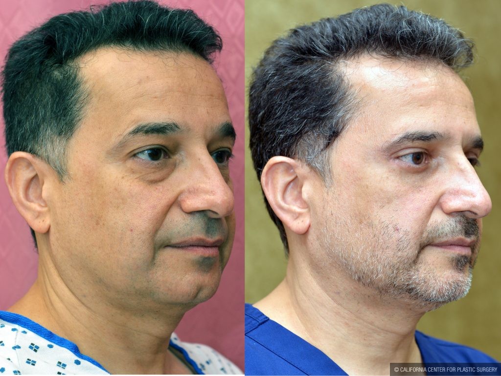 Eyelid (Blepharoplasty) Before & After Patient #14911