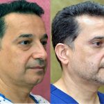 Eyelid (Blepharoplasty) Before & After Patient #14911