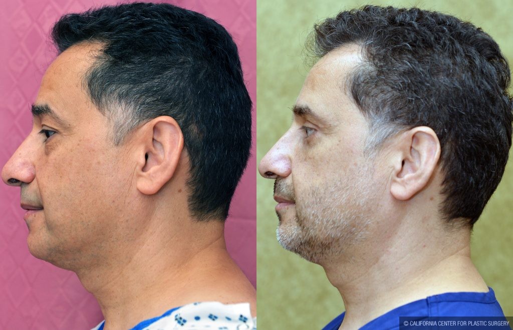 Eyelid (Blepharoplasty) Before & After Patient #14911
