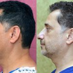 Eyelid (Blepharoplasty) Before & After Patient #14911