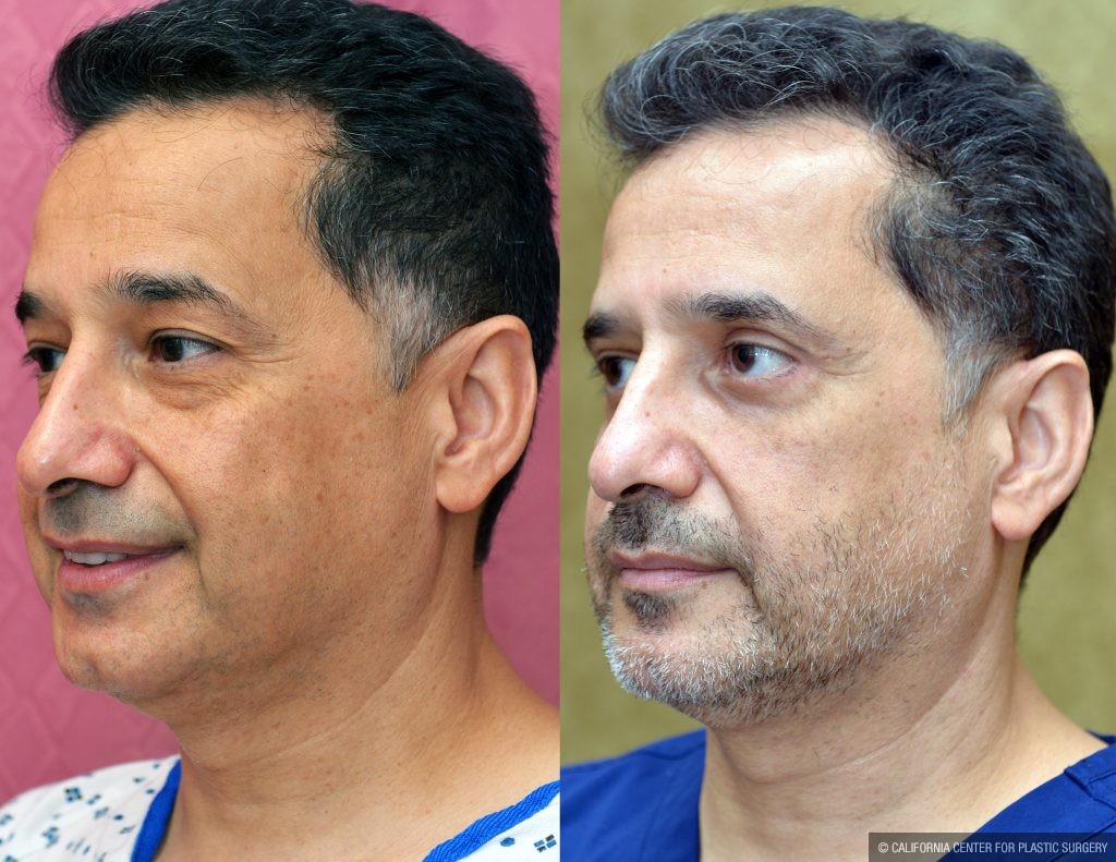 Eyelid (Blepharoplasty) Before & After Patient #14911