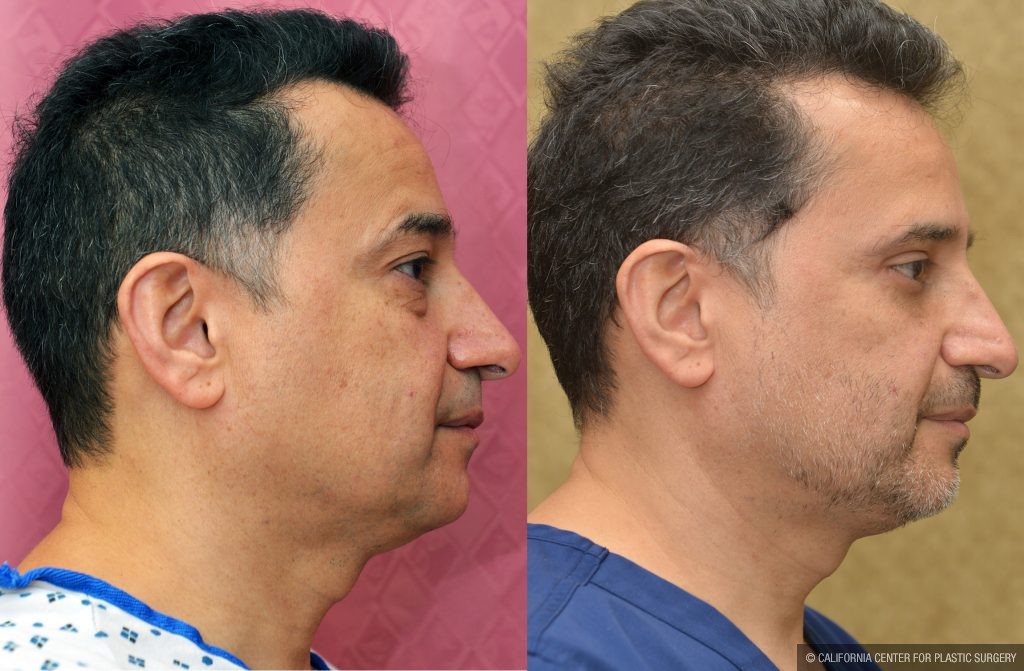 Eyelid (Blepharoplasty) Before & After Patient #14911