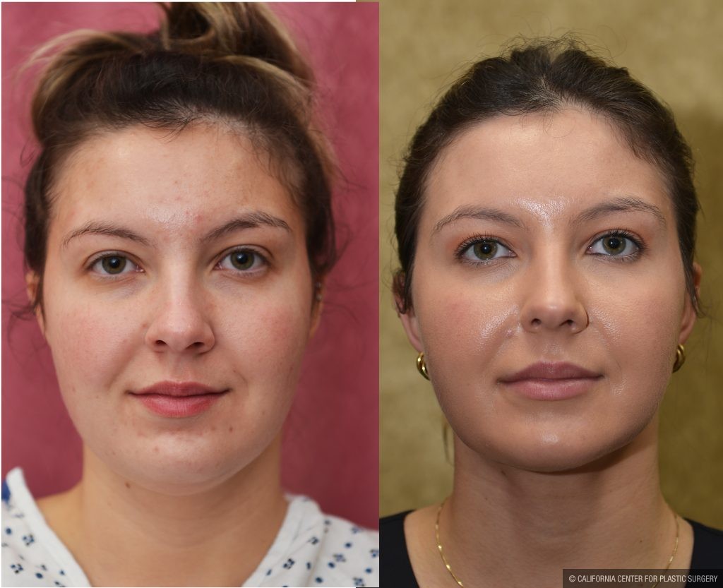 Neck & Face Liposuction Before & After Patient #14905